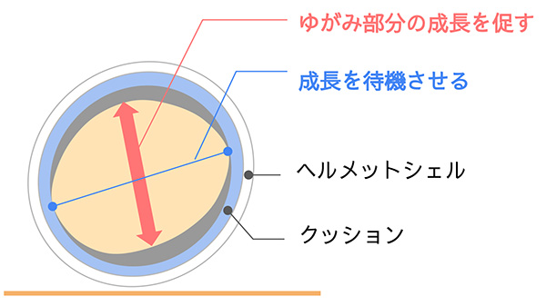 ヘルメット治療の原理